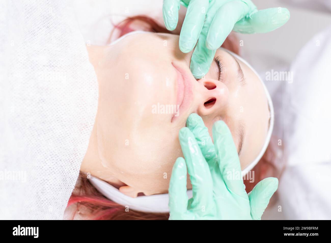Peeling Makeup Problem Portrait of a woman's face with problem skin. Peeling procedure ...