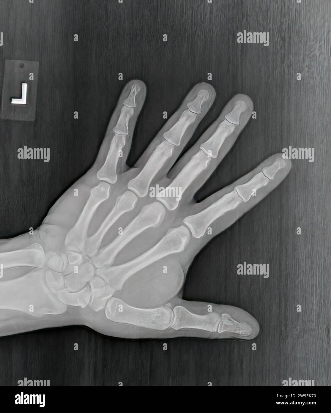 Film xray or radiograph of a normal left hand of an adult male. AP view show human's hand. normal bone structure of all phalanges carpal bones metacar Stock Photo