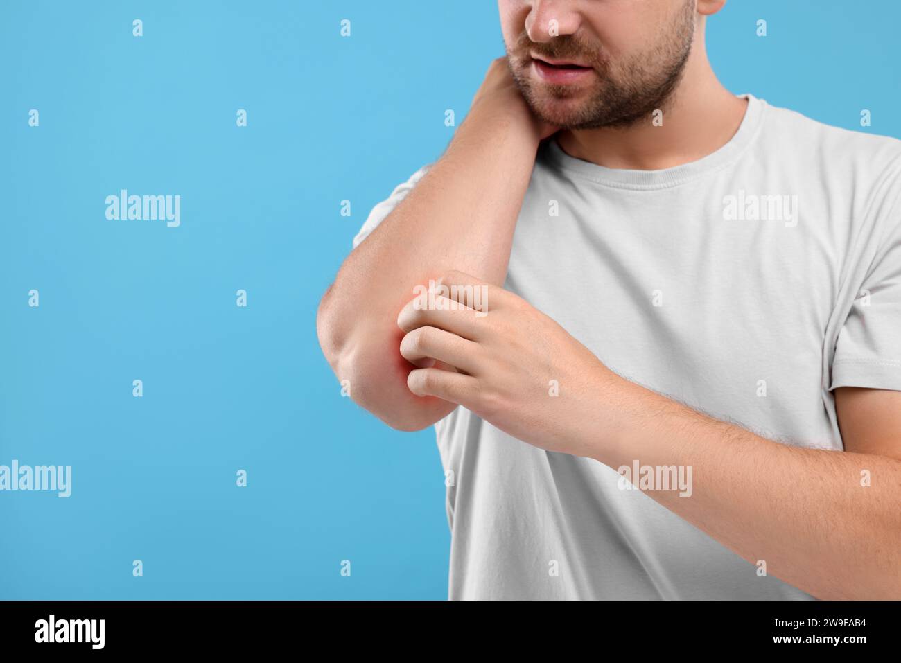 Allergy symptom. Man scratching his arm on light blue background