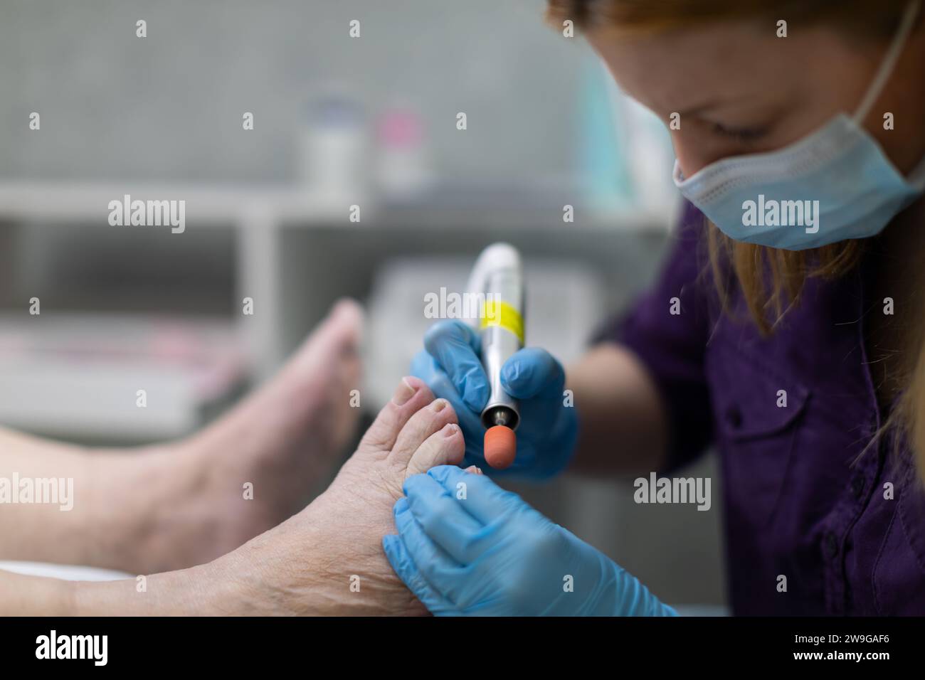 The podiatrist uses an electric nail cutter to remove excess hardened