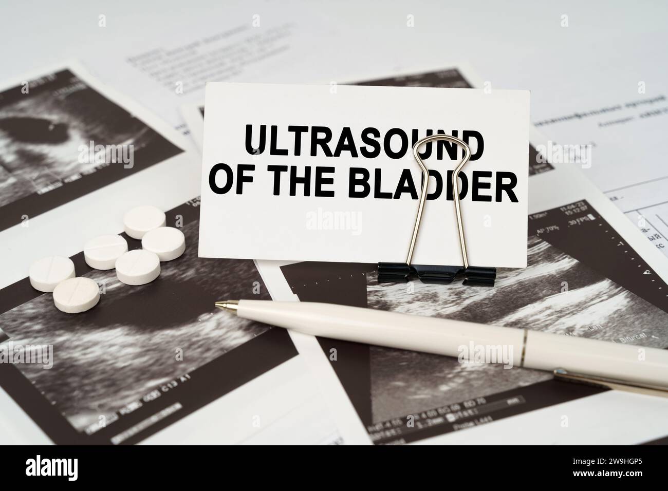 Medical concept. On the ultrasound pictures there is a pen and a business card with the inscription - Ultrasound of the bladder Stock Photo