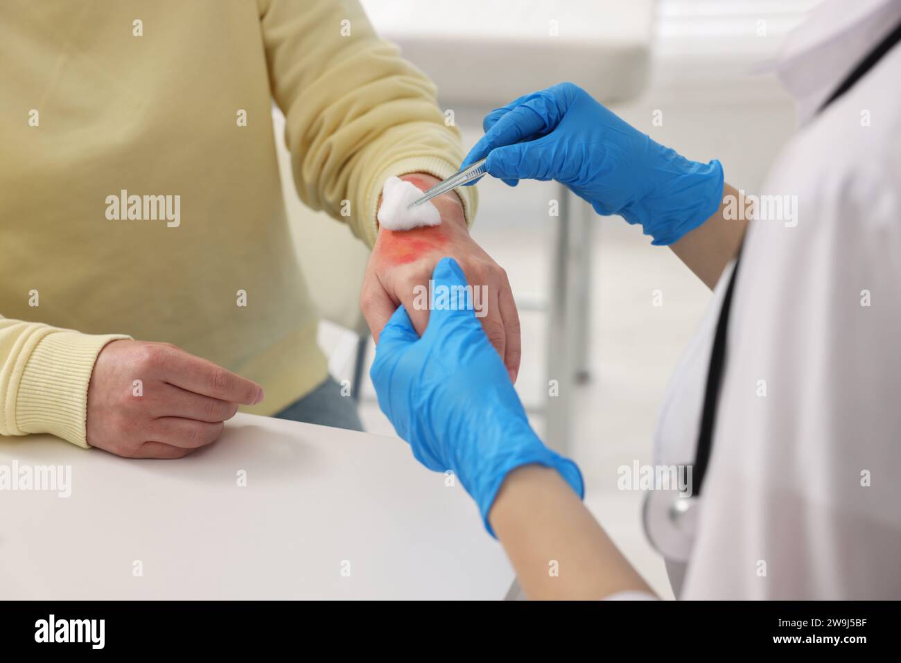 Doctor treating patient's burned hand indoors, closeup Stock Photo