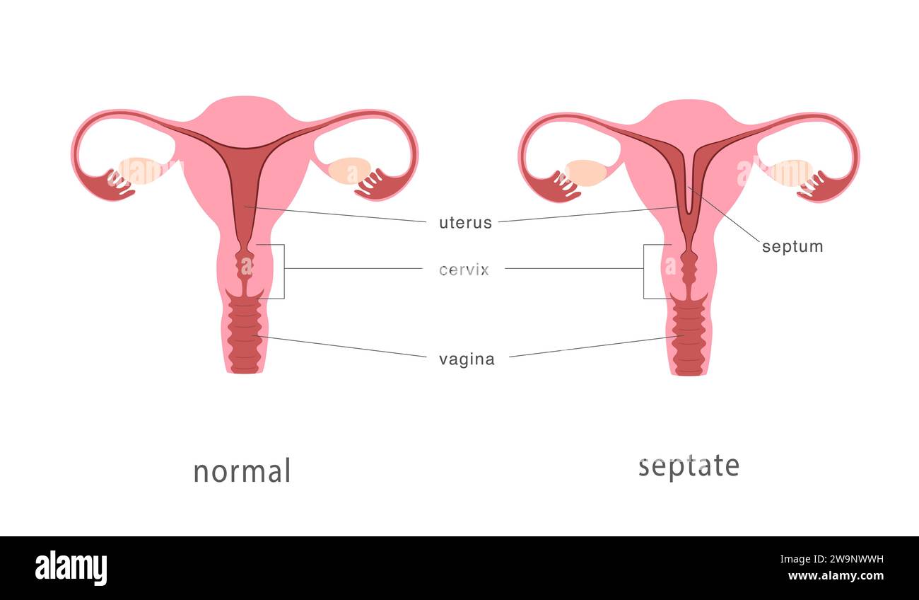 Septate and normal human uterus structure. Uterine septum as a congenital uterine malformation. Anatomy chart. Stock Vector