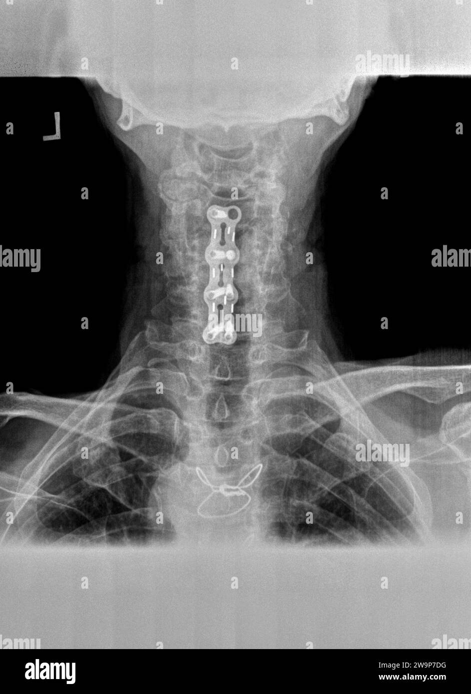 Film xray or radiograph of a cervical neck. AP anterior posterior view showing surgical bracket to help stabilize the patients neck Stock Photo