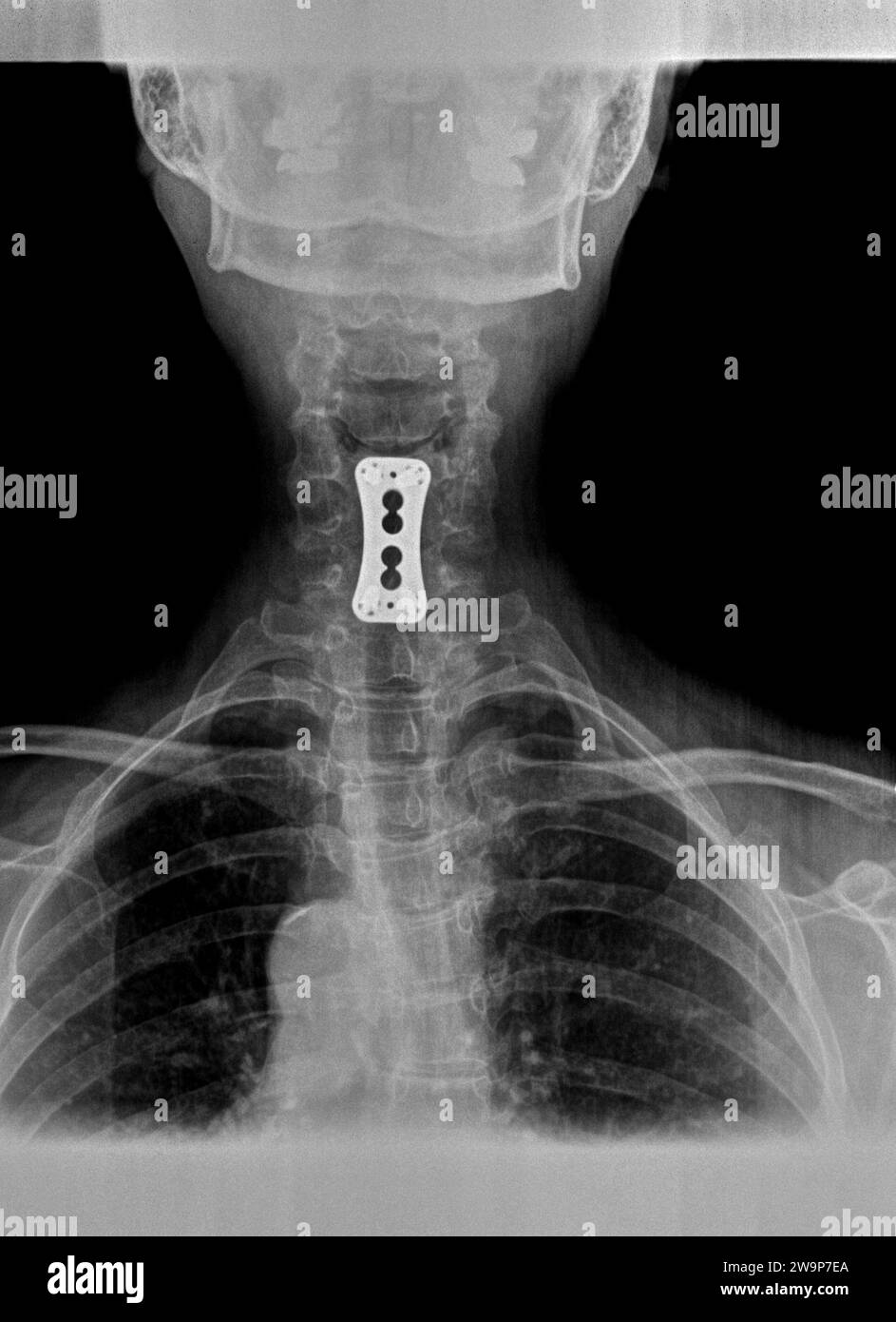 Film xray or radiograph of a cervical neck. AP anterior posterior view showing surgical bracket to help stabilize the patients neck Stock Photo