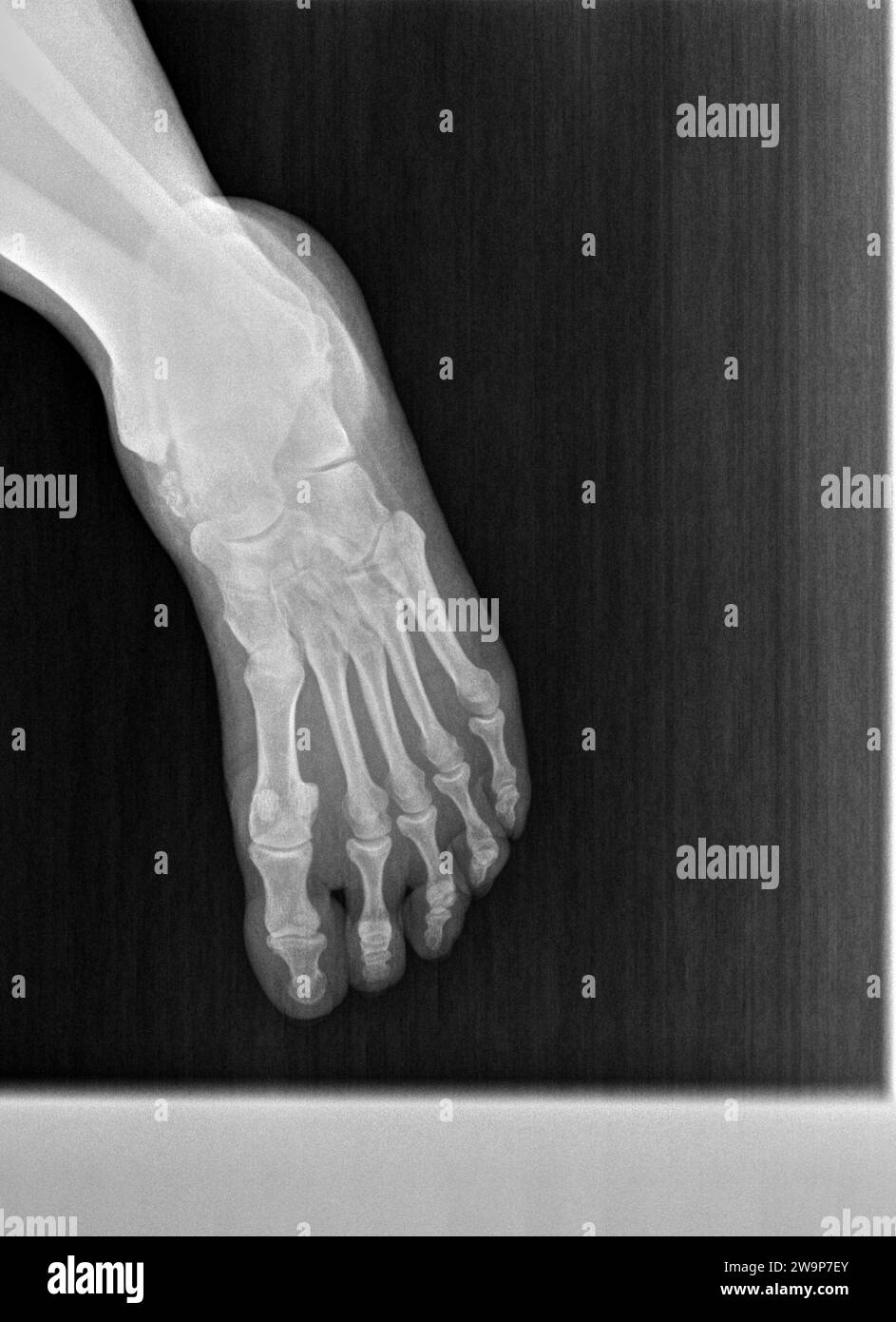 Film xray or radiograph of a normal foot, ankle and leg. dorsal anterior posterior view showing normal bone structure. joint space is normal Stock Photo