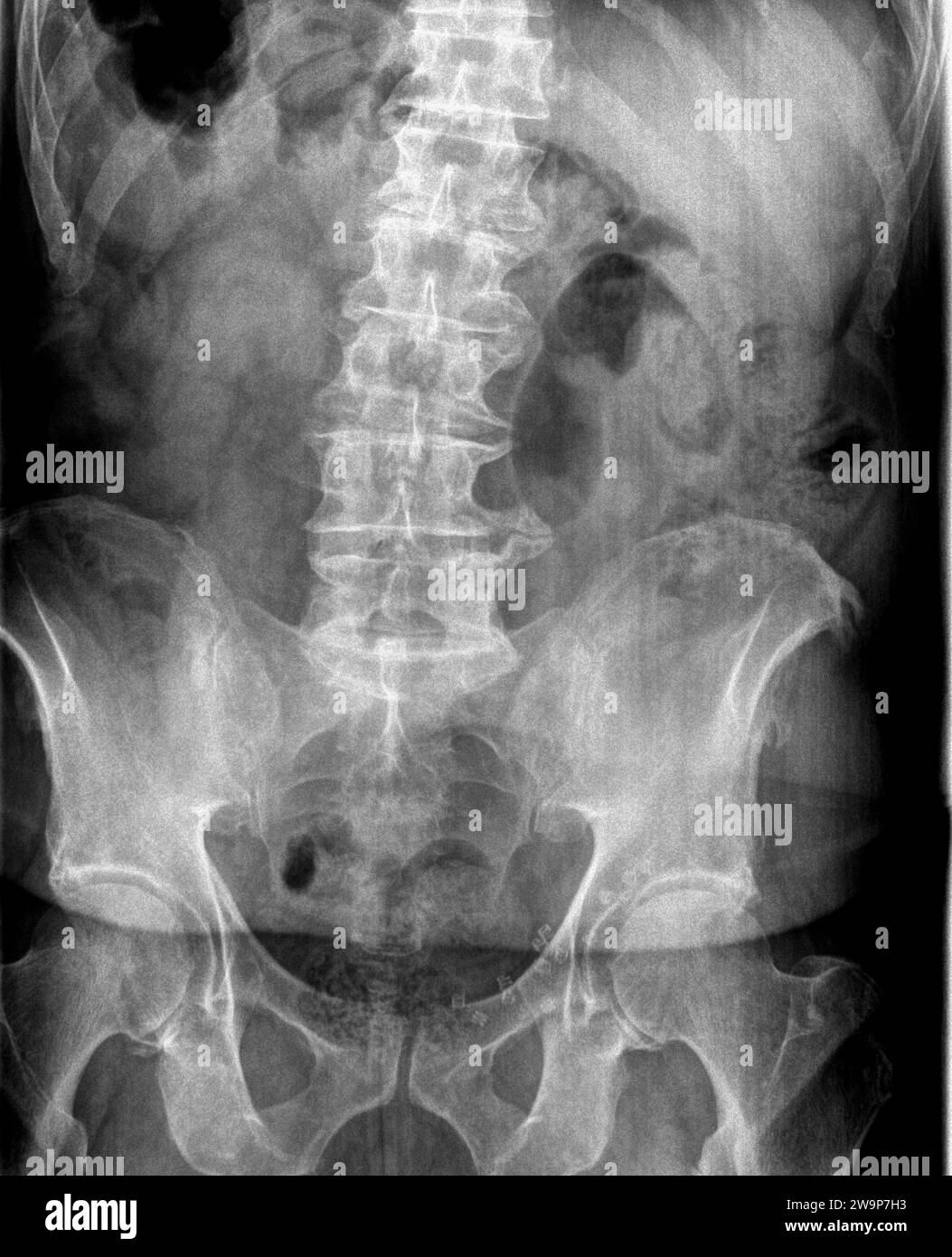 Film x ray or radiograph of an adult lumbar vertebrae anterior posterior AP view showing a very large osteophyte bone spur on L4 L5 right side transve Stock Photo