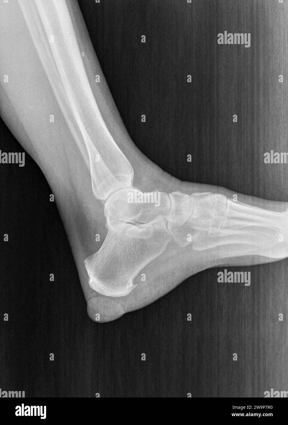 Film xray or radiograph of a normal foot, ankle and leg. Lateral view