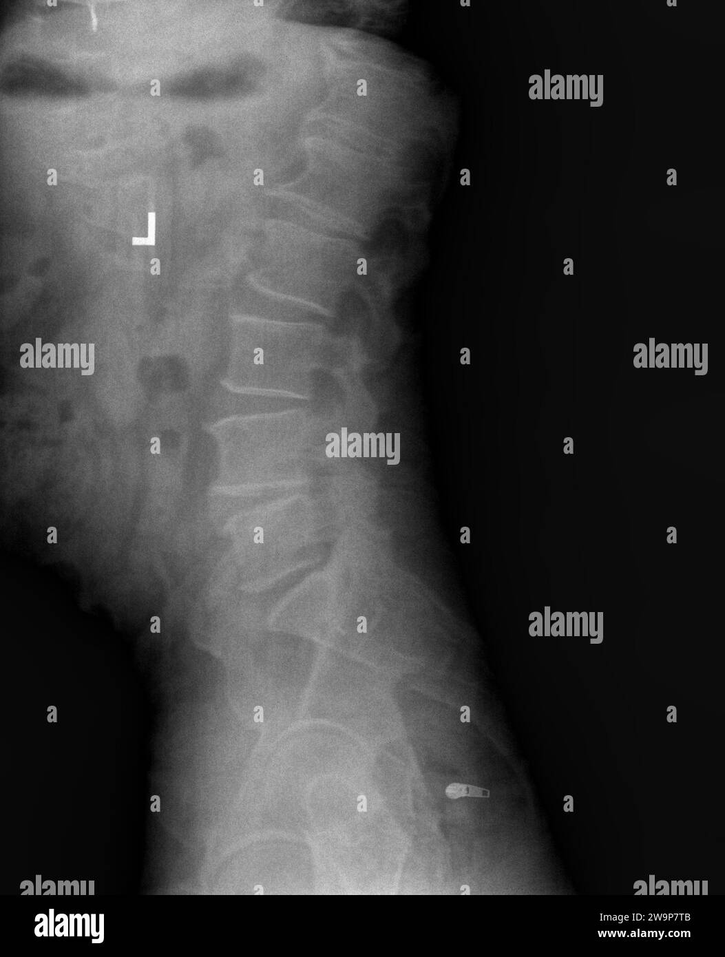 Film xray or radiograph of lumbar low back vertebrae showing facet joint syndrome of L4 L5 area which is an arthritis-like condition of the spine that Stock Photo