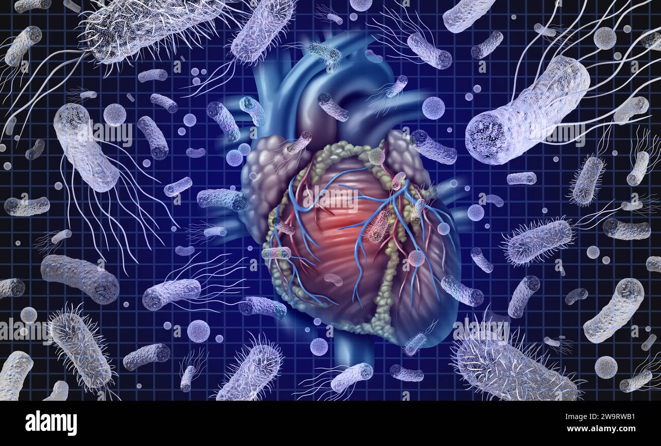 Bacterial Endocarditis or Heart And Bacteria and septicemia or sepsis as blood poisoning due to germs. Stock Photo