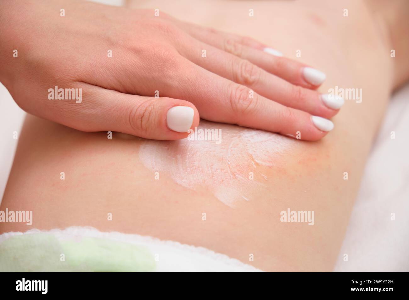 The mother is applying cream to the allergic rash on her child's body. A woman is treating her baby's eczema with a special cream. Stock Photo