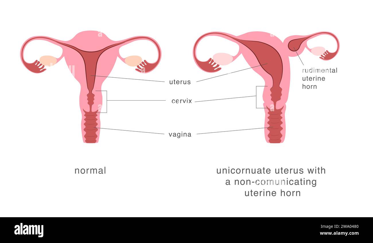 Utures Shape Normal human uterus and unicornuate uterus with non-comunicating ...