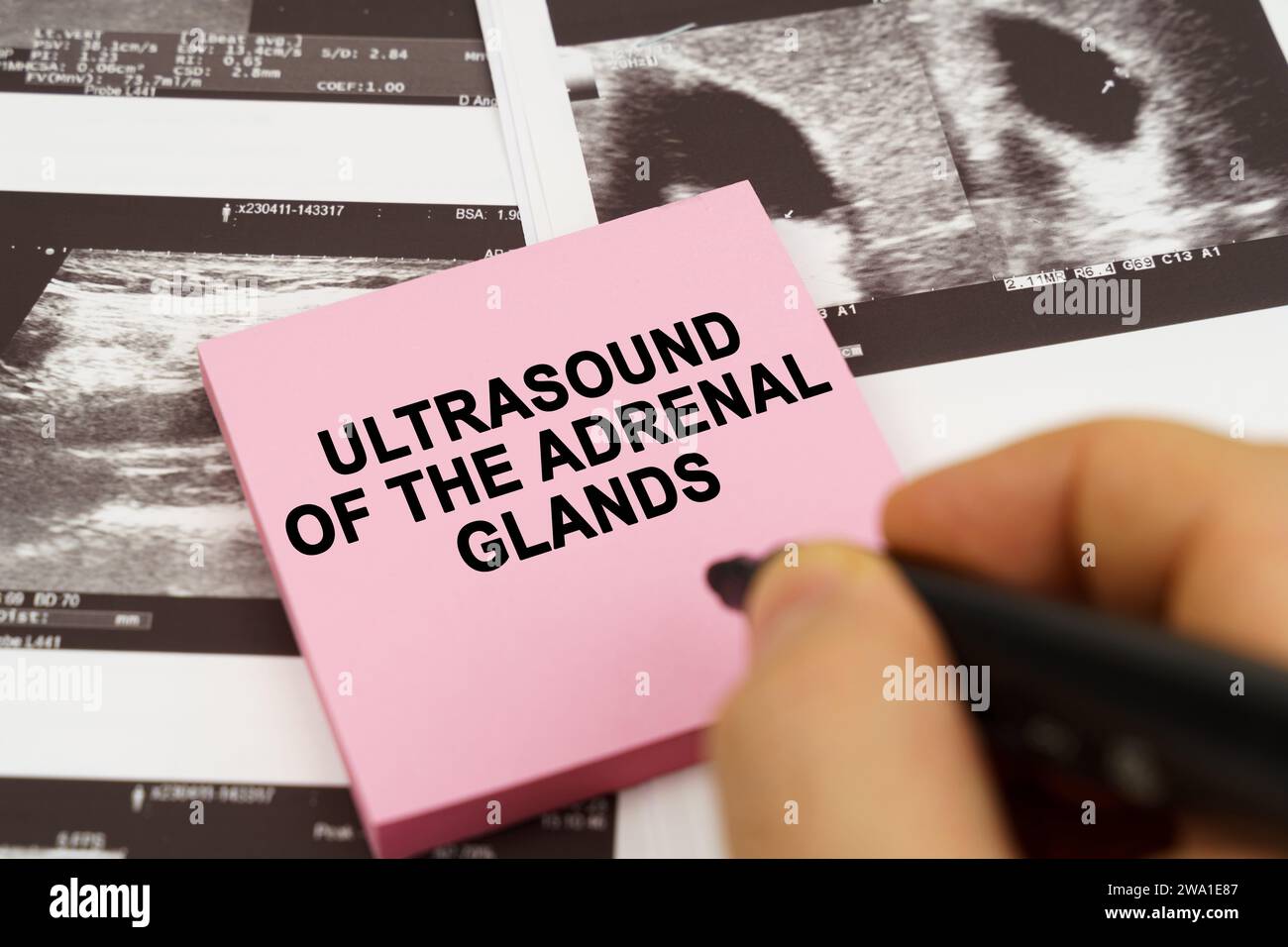 Ultrasound of the adrenal glands hires stock photography and images