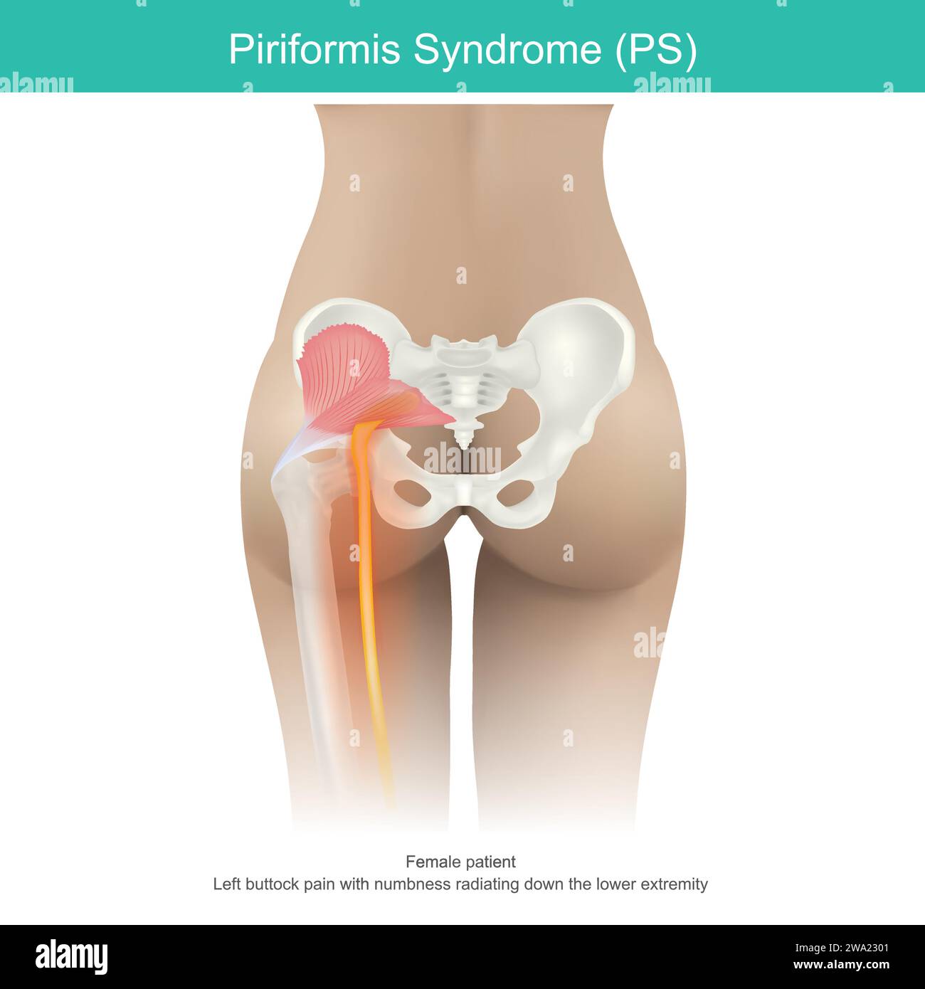 Piriformis syndrome. a condition in which nerve compression in the muscles, located in the buttock region causes buttocks pain and down to thigh in wo Stock Vector