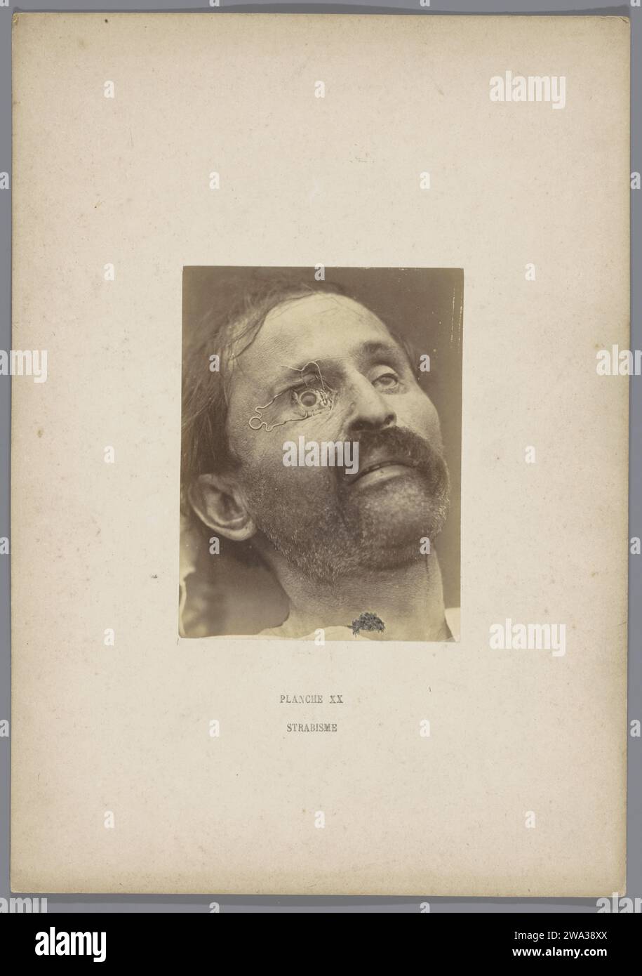 Patient with an open eye for surgery for sternzing (Strabismus), A. de Montméja, c. 1865 - Before c. 1870 photograph  France photographic support albumen print operation, surgery. cross-eyed; squint. eyes Stock Photo