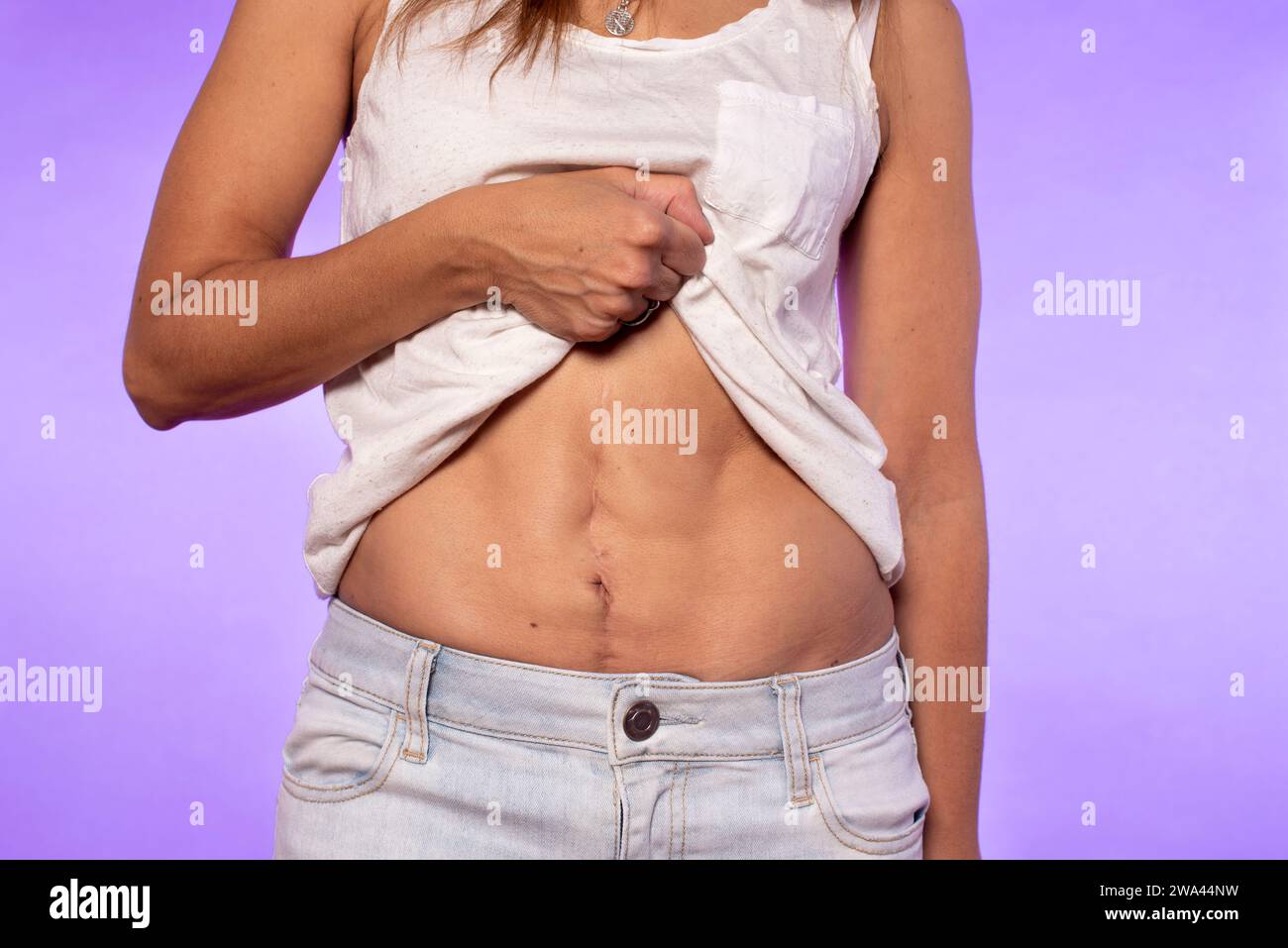 Woman showing an abdominal scar after surgery Stock Photo