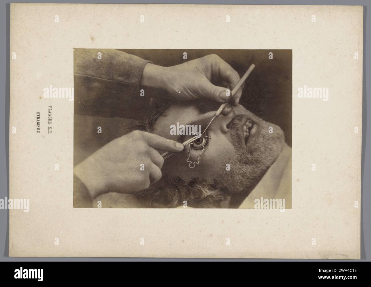 Eye surgery for stabbing (strabismus), A. de Montméja, c. 1865 - Before c. 1870 photograph  France photographic support albumen print operation, surgery. cross-eyed; squint. eyes Stock Photo