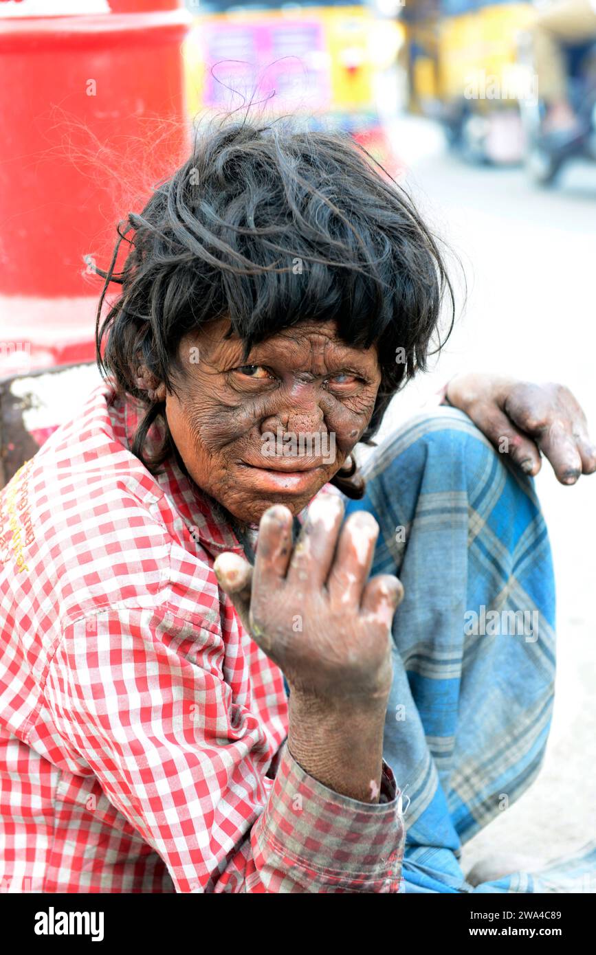 Portrait of a leper man taken in Hyderabad, India. Stock Photo