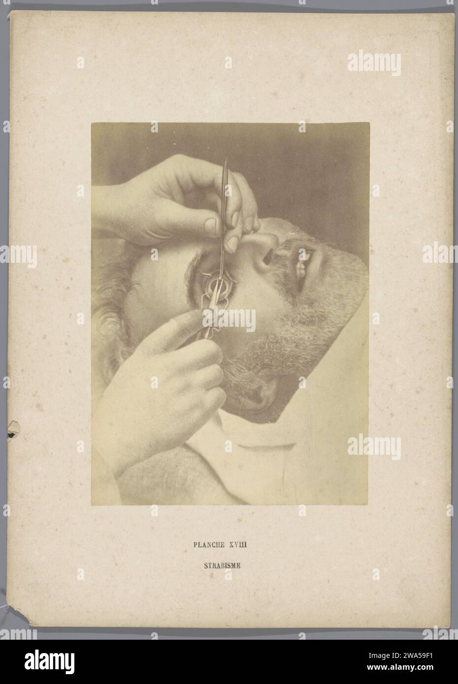 Photo production of a drawing, representing an eye surgery for stabbing (Strabismus), A. de Montméja, After Anonymous, c. 1865 - Before c. 1870 photograph  France photographic support albumen print operation, surgery. cross-eyed; squint. eyes Stock Photo