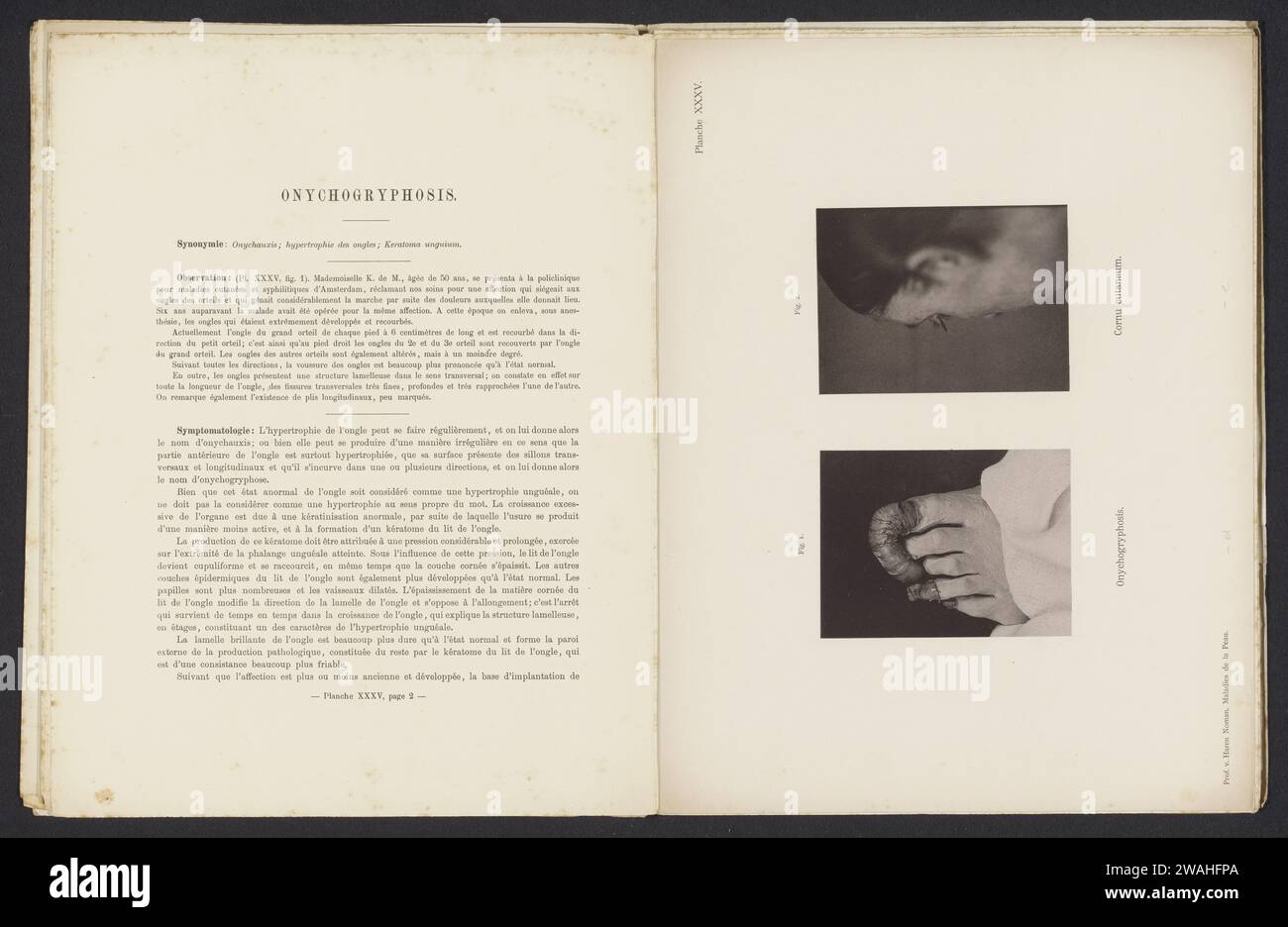 Patients suffering from the skin disease 'Onychogyphosis' and 'Cornu cutaneum', c. 1886 - in or before 1896 photomechanical print  Amsterdampublisher: Haarlem paper collotype skin and venereal diseases. adult woman. face. foot. toes Stock Photo