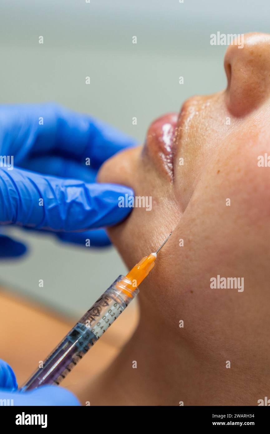 A Filling of the nasolabial fold with hyaluronic acid by injection Stock Photo