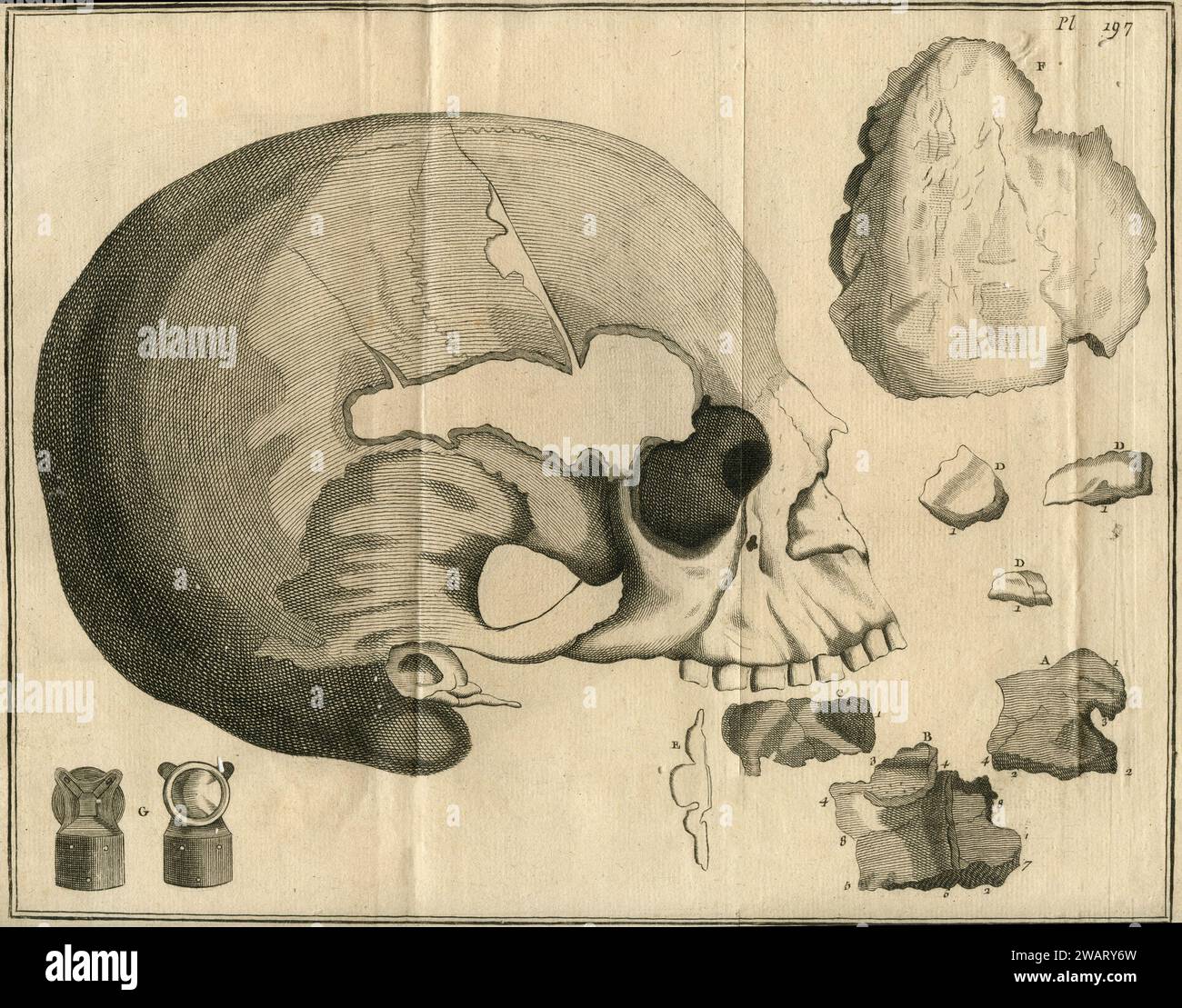 Vintage anatomy drawing: Deformed human skull, Transation Philosophique, France 1700s Stock Photo