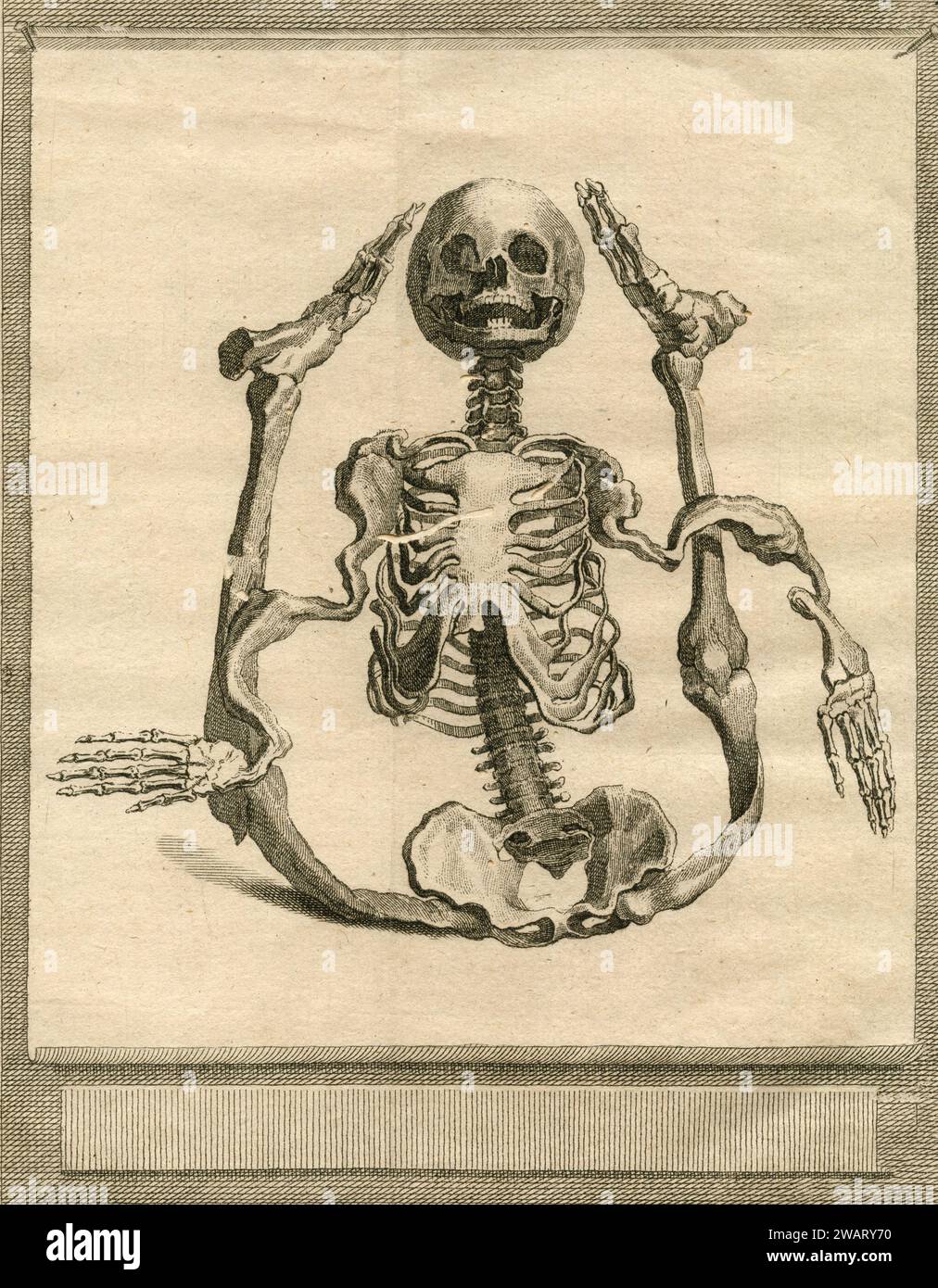 Vintage anatomy drawing: Deformed human skeleton, Transation Philosophique, France 1700s Stock Photo
