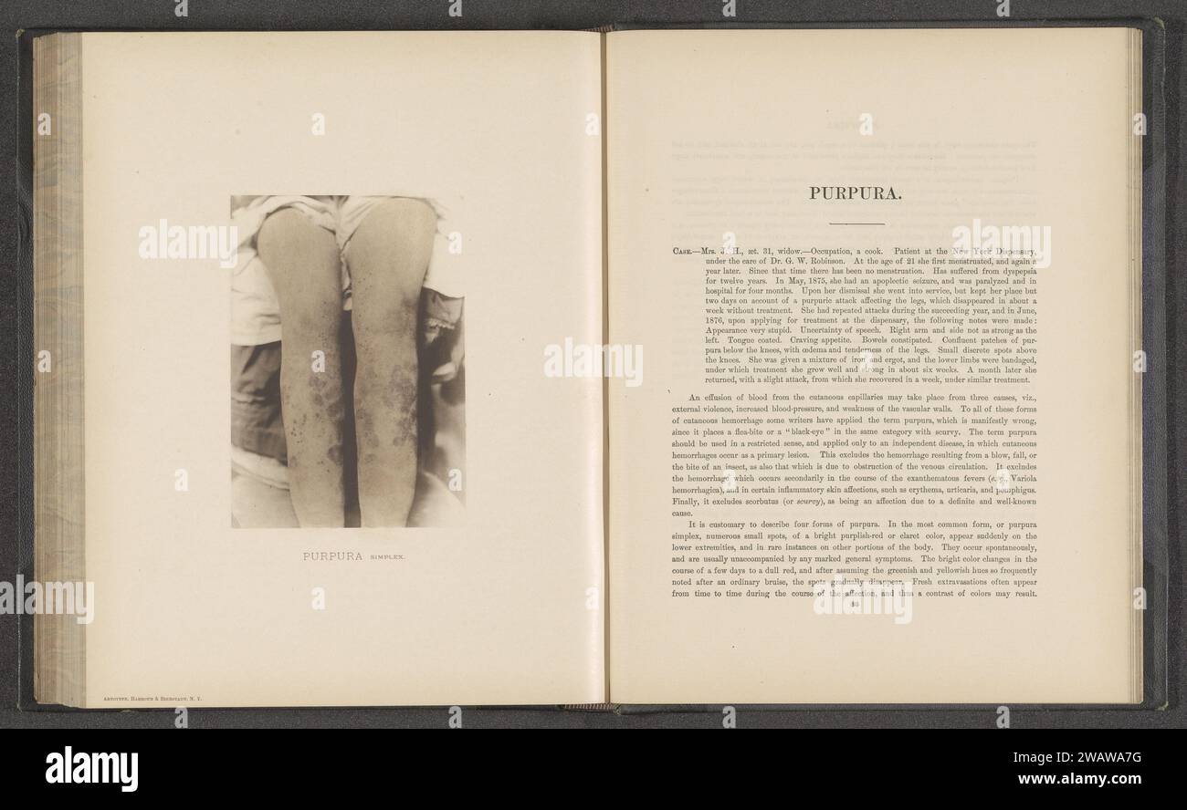 Patient suffering from the skin disease 'purpura simplex', c. 1870 - in Or Before 1881 photomechanical print  New York (city) paper collotype skin and venereal diseases. legs Stock Photo