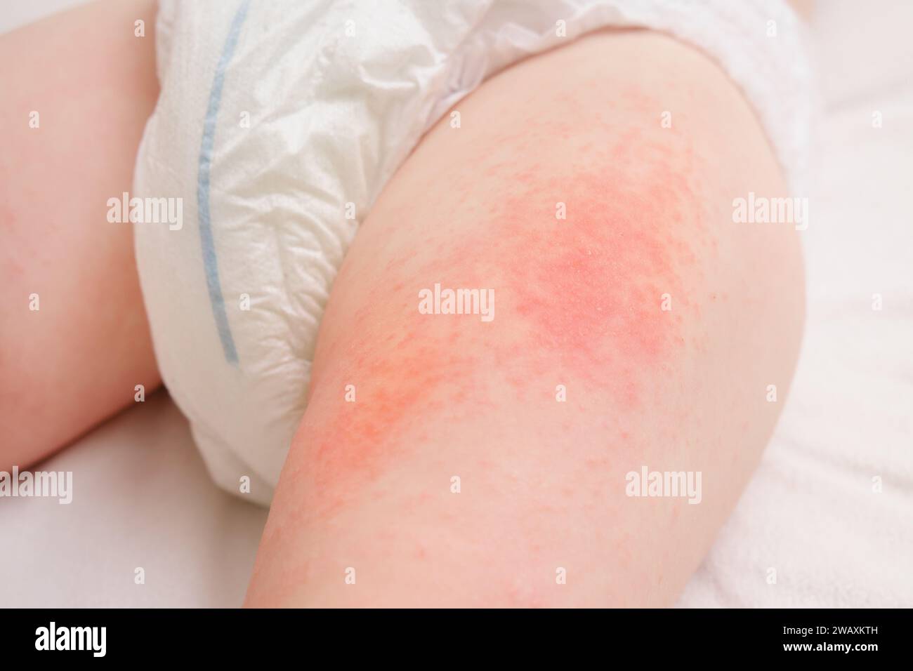 Allergic rash on the legs of the toddler baby boy. Red pimples from allergies on the child's body. Stock Photo