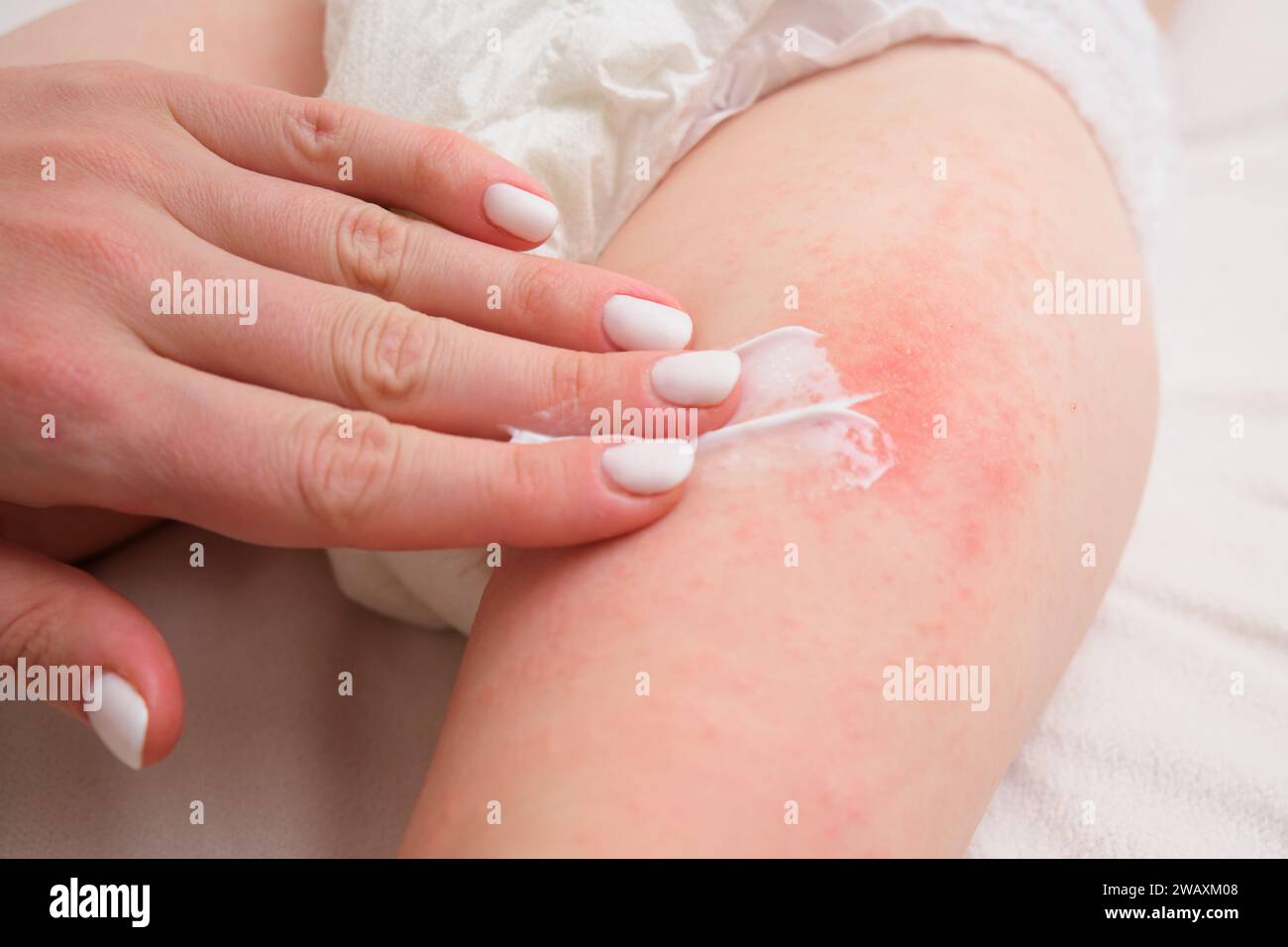 The mother is treating her child's pimple allergy with a cream. The woman is gently applying cream on the irritated skin of her baby's leg. Stock Photo