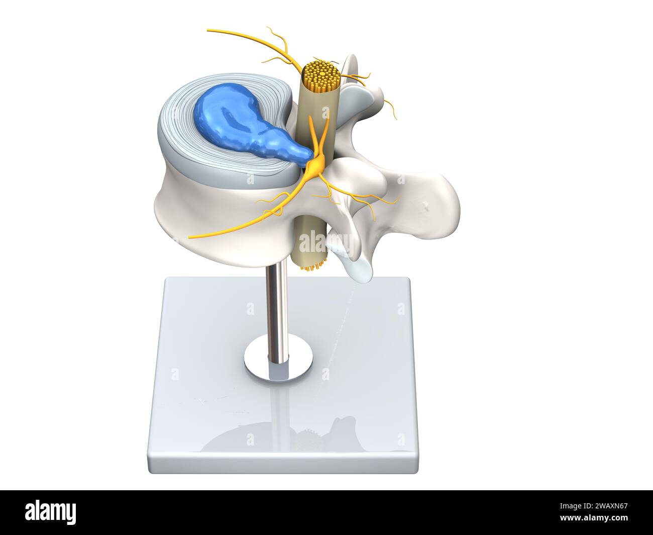 Illustration showing model of a herniated disc of the lumbar spine, stenosis, slipped disc. 3D Illustration Stock Photo