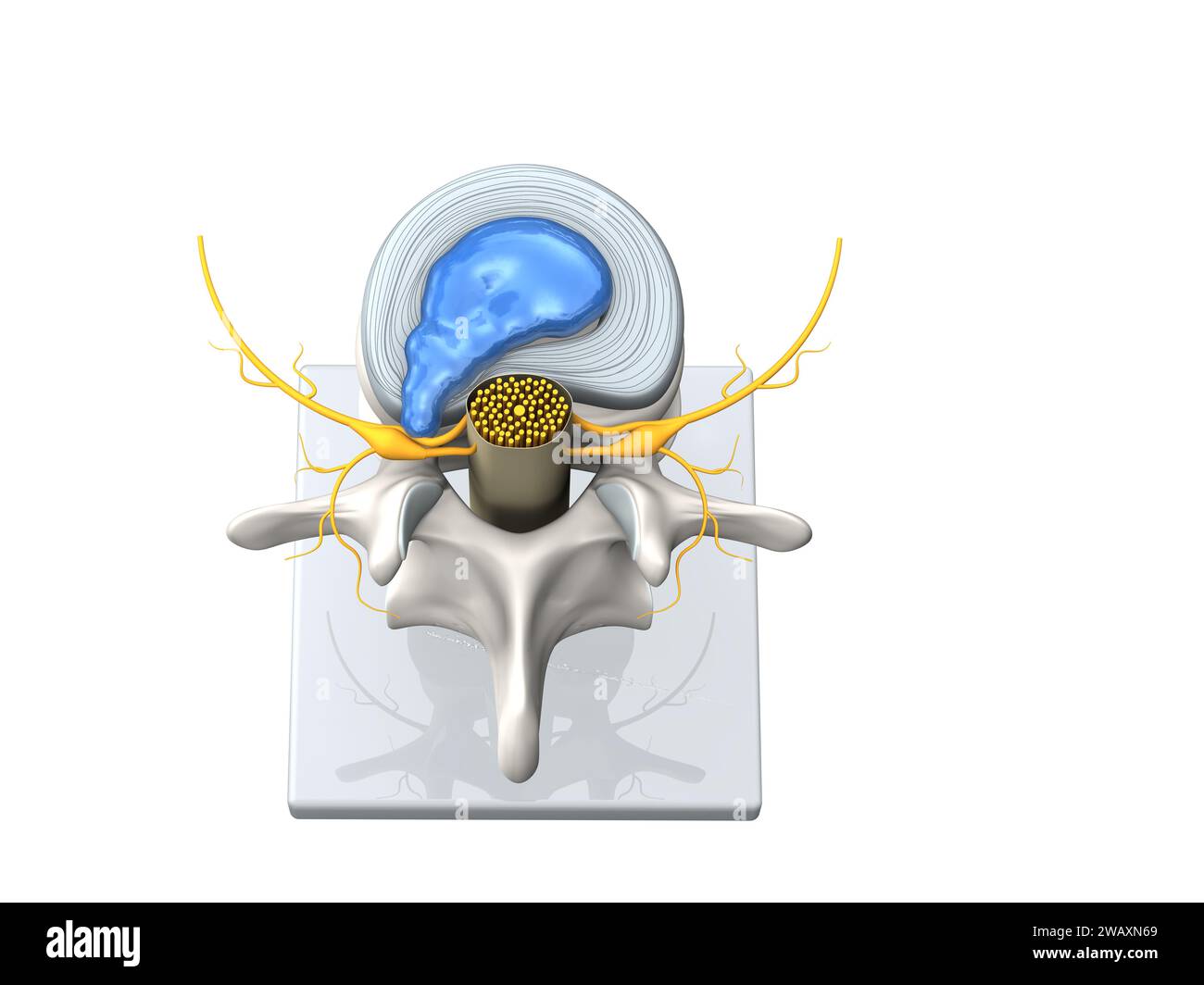 Illustration showing model of a herniated disc of the lumbar spine, stenosis, slipped disc. 3D Illustration Stock Photo