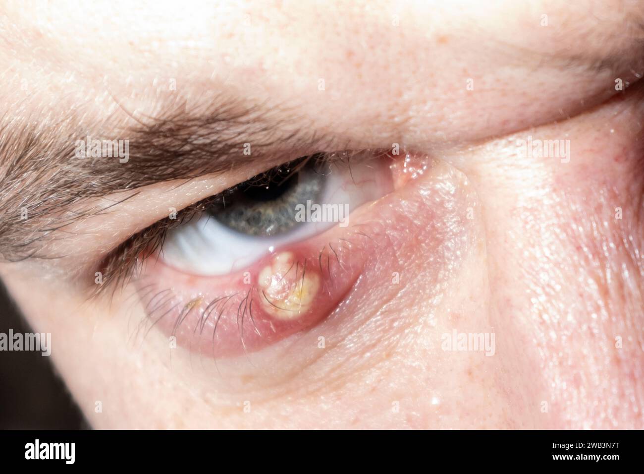 Eye of a guy with stye close-up. Acute red purulent inflammation of the hair follicle of the eyelashes of a man. Stock Photo