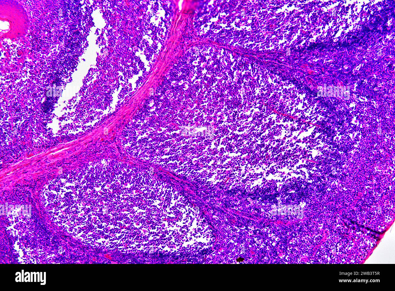Human palatine tonsil section showing circular lymphoid follicles and secretory gland. Light micrograph, haematoxylin eosin stain. X75 when printed 10 Stock Photo
