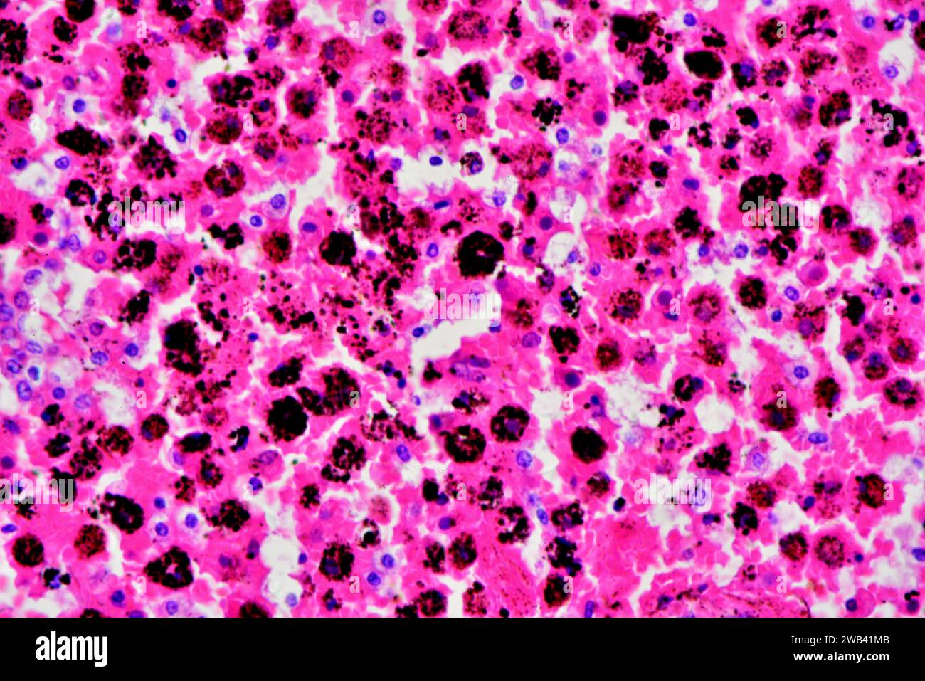 Human smoker's lung with carbon particles (black). Photomicrograph X300