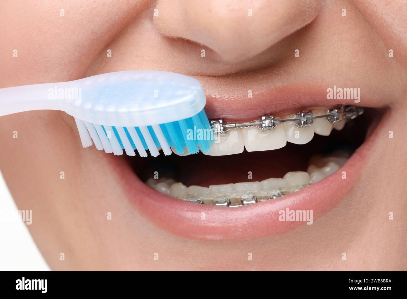 Woman brackets on teeth hires stock photography and images Alamy