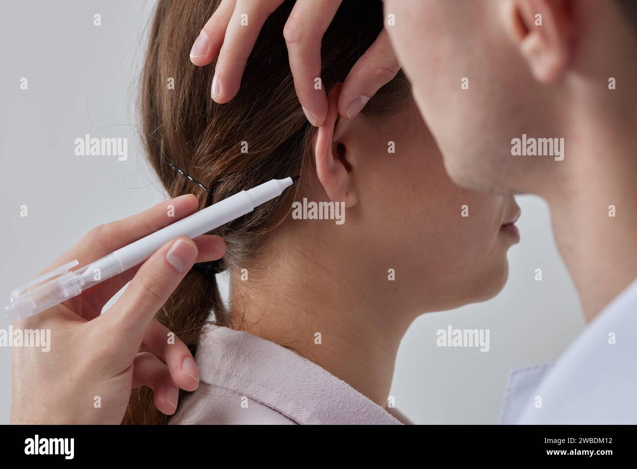 Otoplasty markup for surgical reshaping of the pinna, or outer ear for correcting an irregularity and improving appearance. Surgeon doctor marking gir Stock Photo