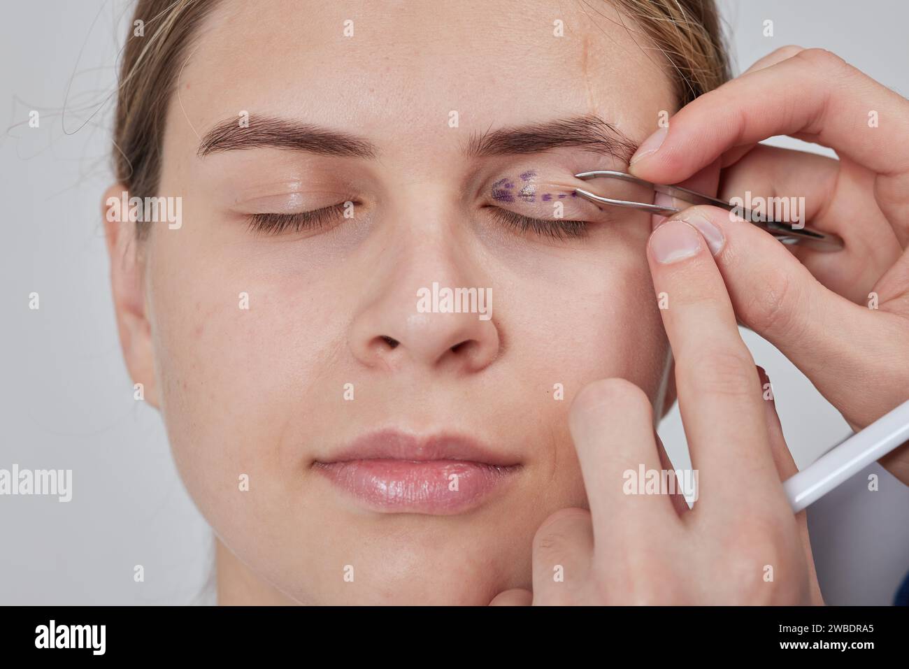 plastic surgeon prepares for Blepharoplasty, Blepharoplasty operation