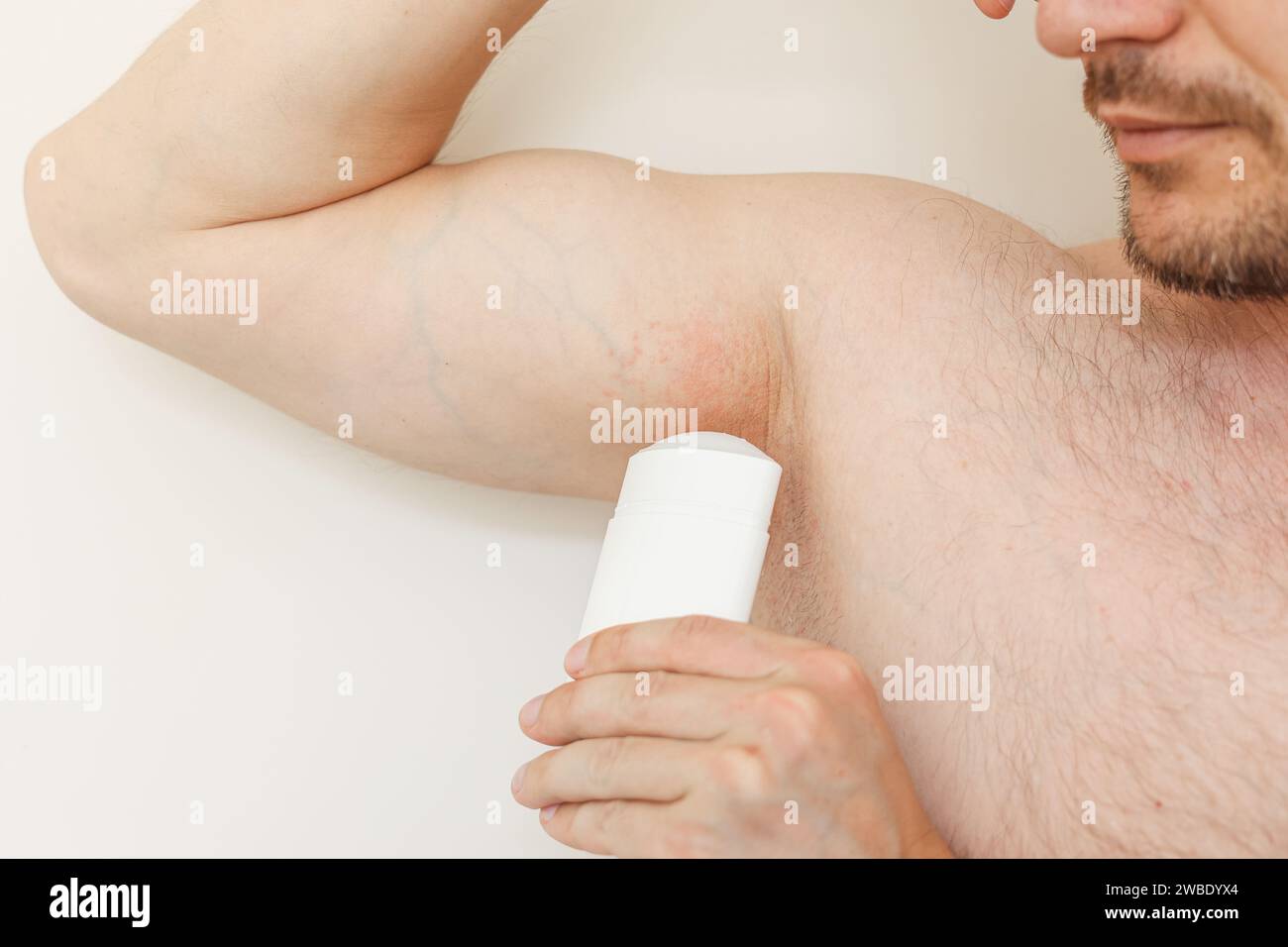 Young man with irritation, inflammation on sensitive underarm skin, using deodorant or