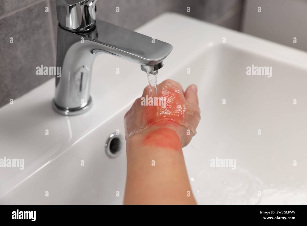 Burn skin cold water hires stock photography and images Alamy