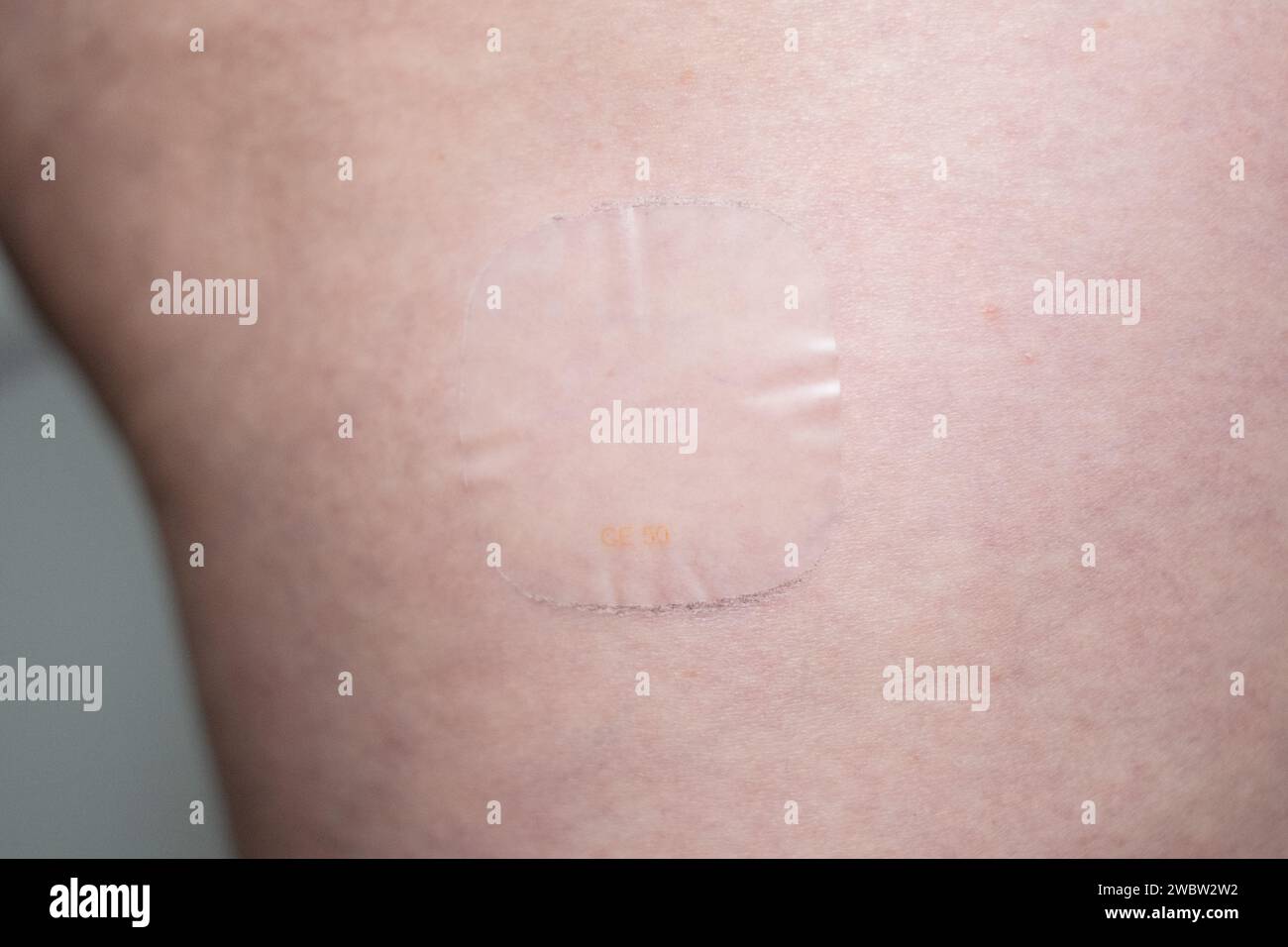 Hormone Replacement Therapy medication Evorel 50 (estradiol) patch on