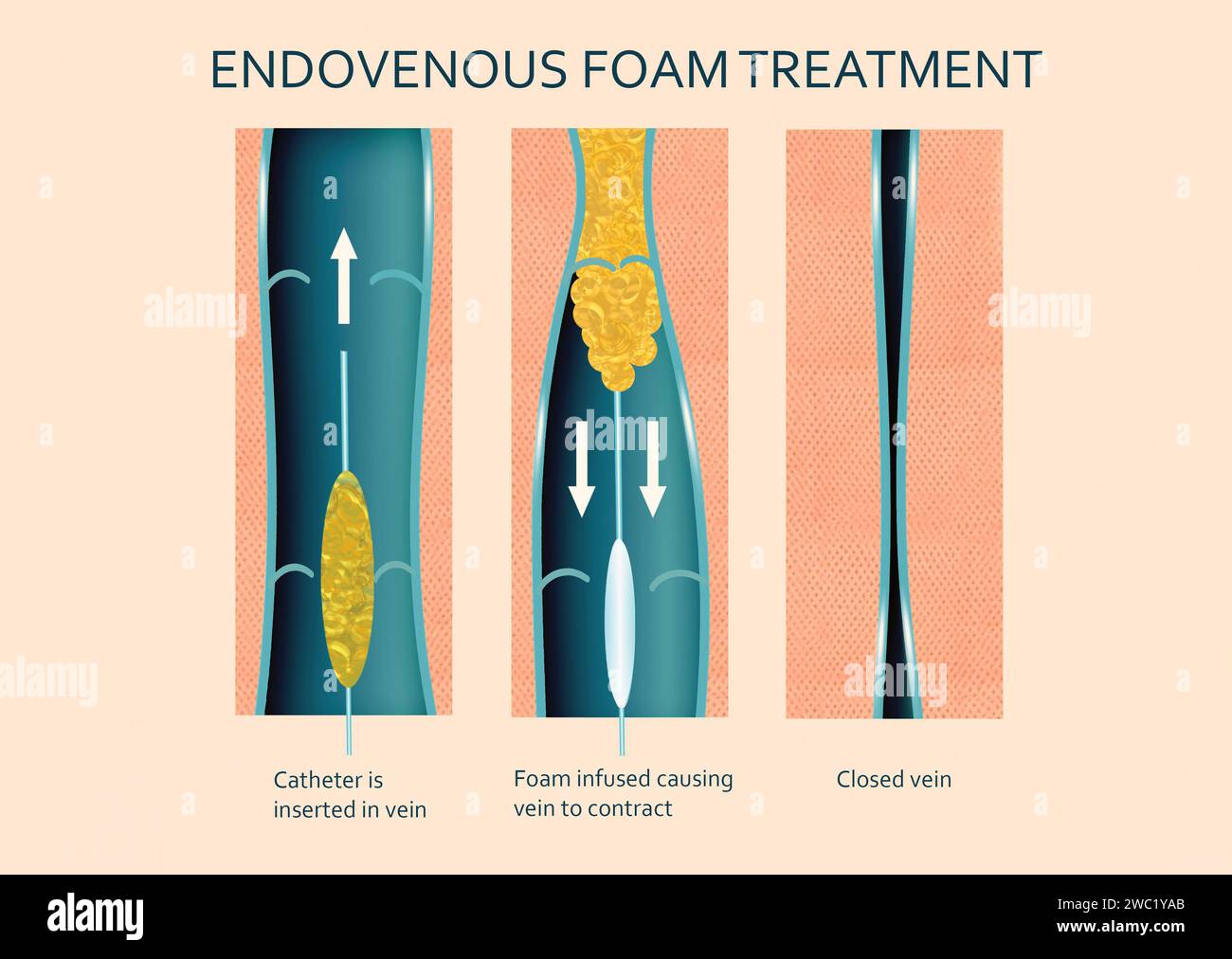 Varicose Veins. Endovenous foam Treatment. When injected inside a vein