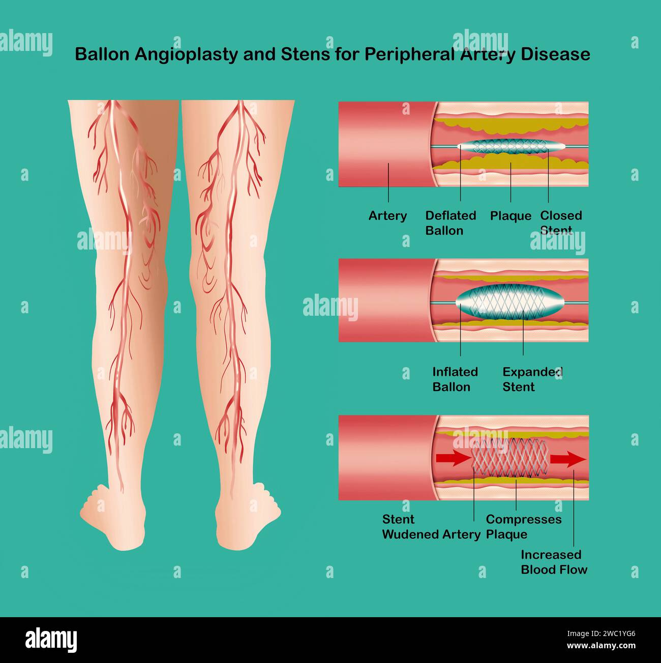 Diagram showing angioplasty for peripheral artery disease illustration