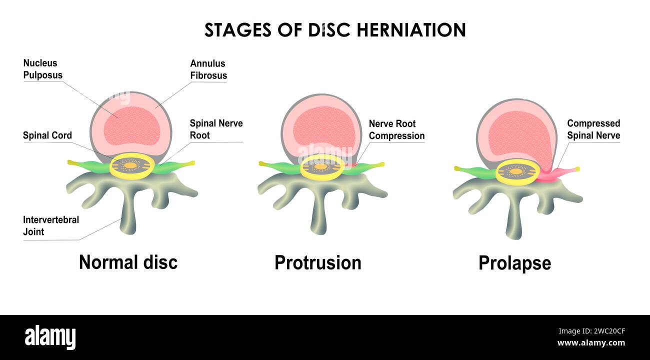 Difference between Bulging Disc and Herniated Disc. Stages of Spinal Disc extrusion. Stock Photo