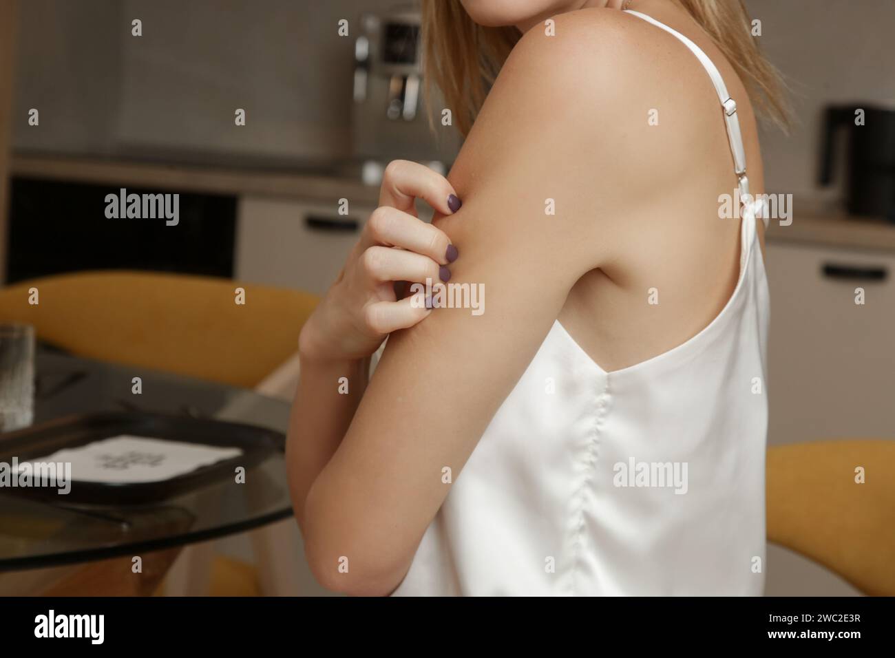 Woman scratching arm, suffering from skin allergy, rash, dermatitis or eczema. Stock Photo