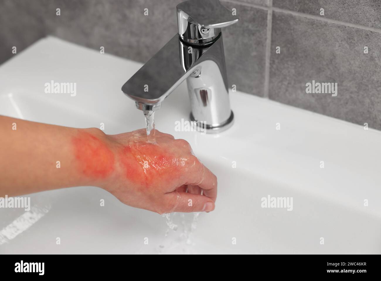Woman holding burned hand under cold water indoors, closeup Stock Photo Alamy