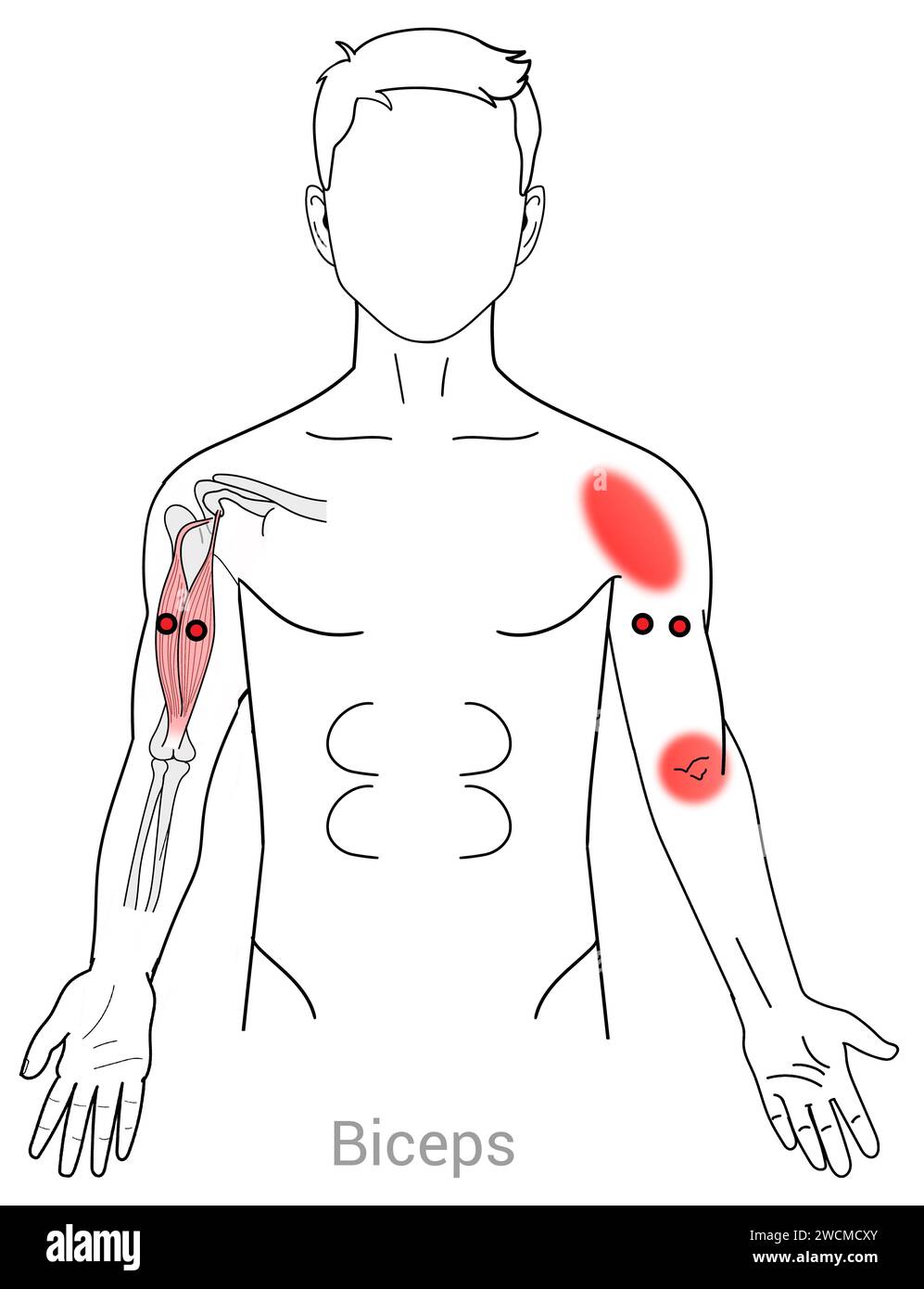 Biceps Myofascial trigger points and associated pain locations Stock