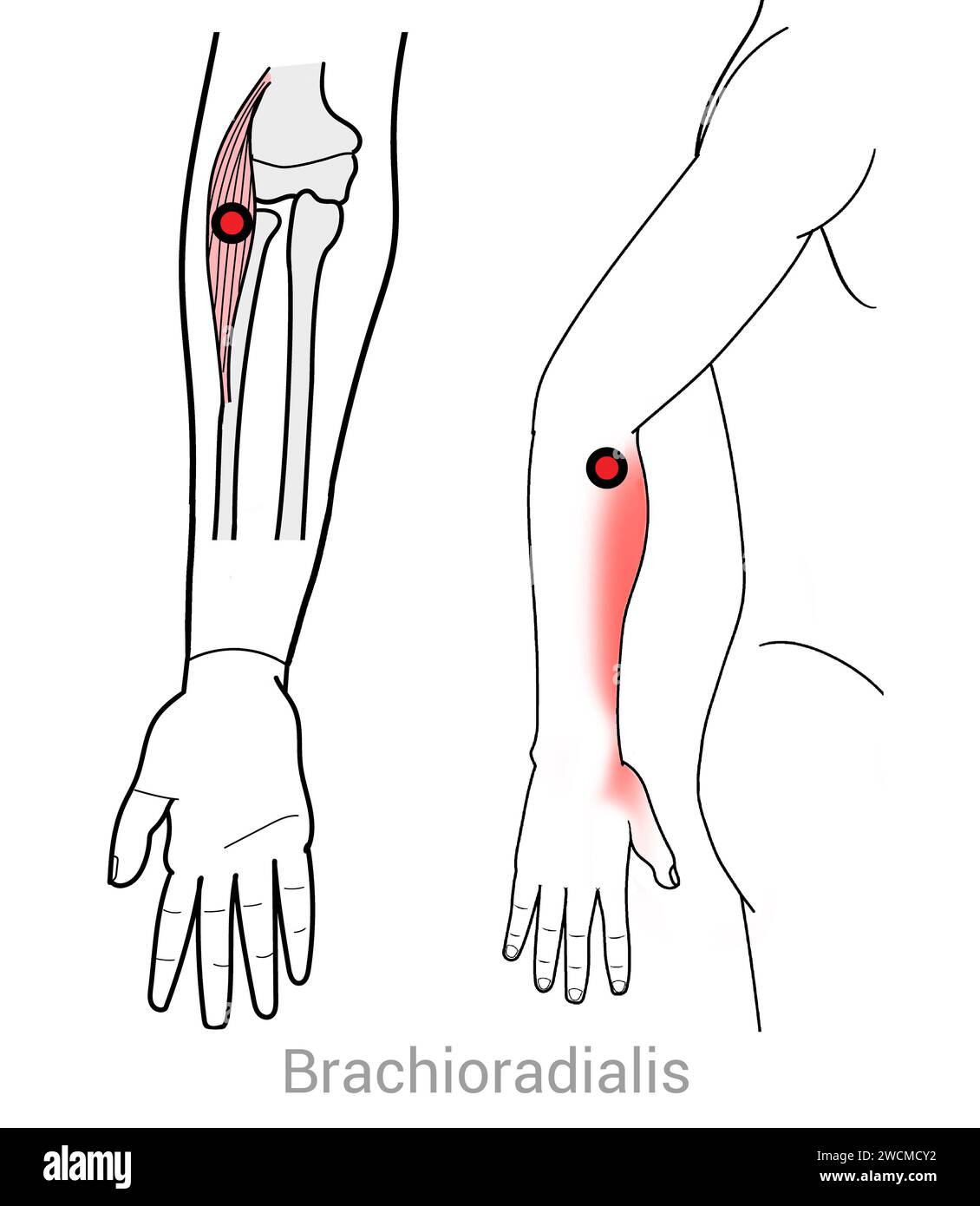 Brachioradialis Myofascial trigger points and associated pain locations Stock Photo Alamy