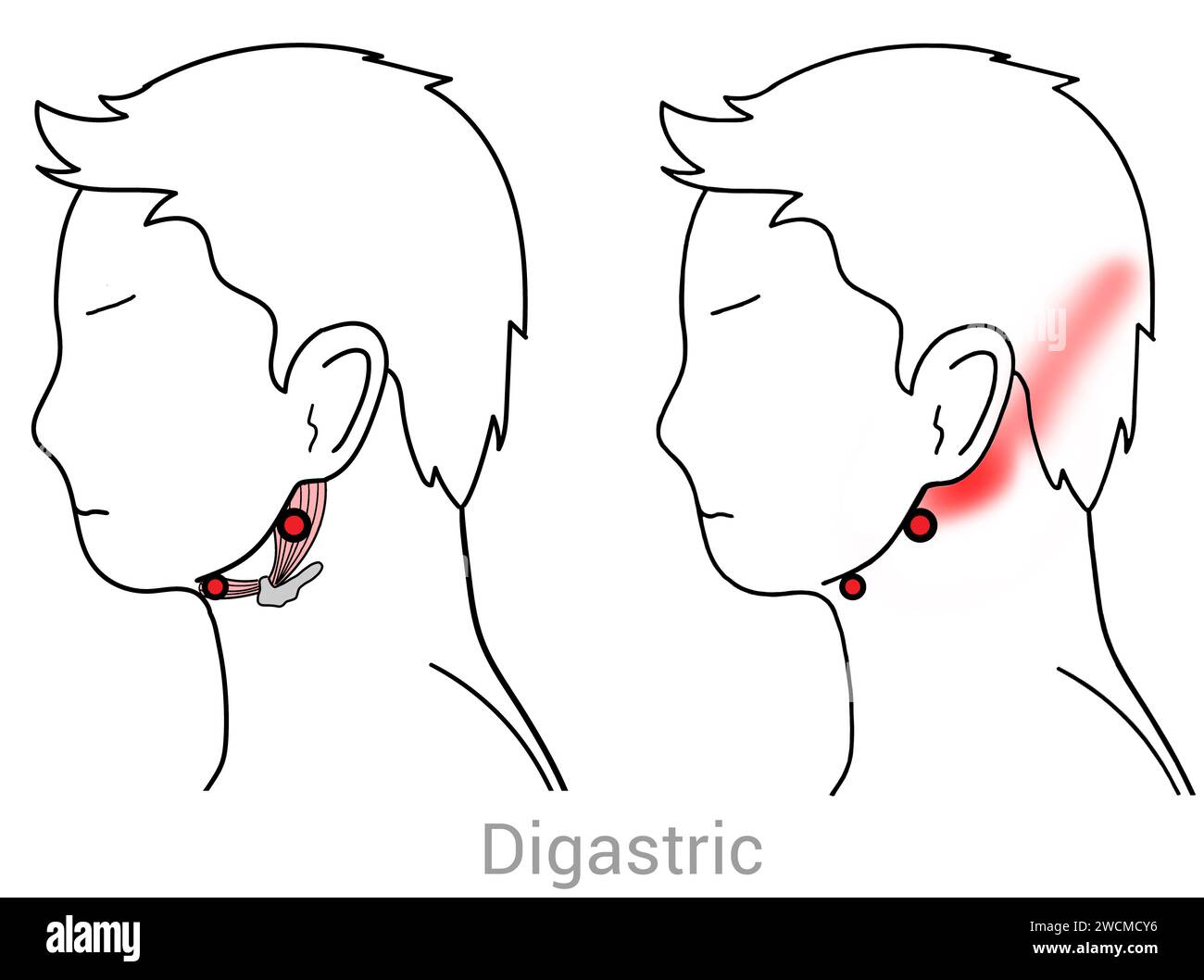 Digastric: Myofascial trigger points and associated pain locations Stock Photo