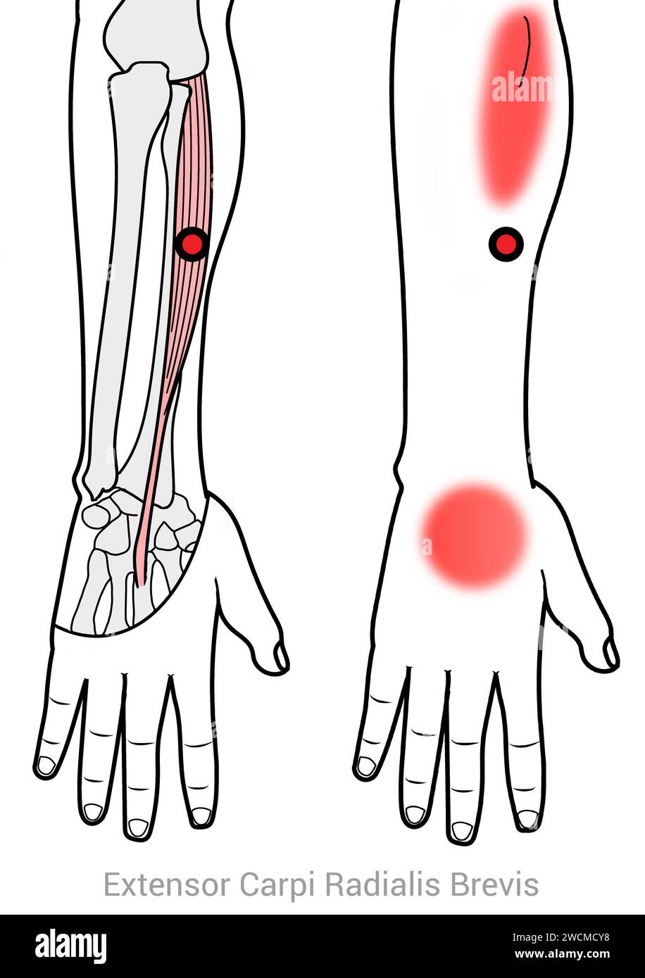 Extensor Carpi Radialis Brevis: Myofascial trigger points and associated pain locations Stock Photo
